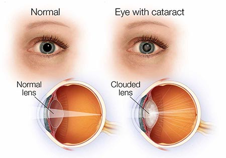 Normal eye vs Cataract eye