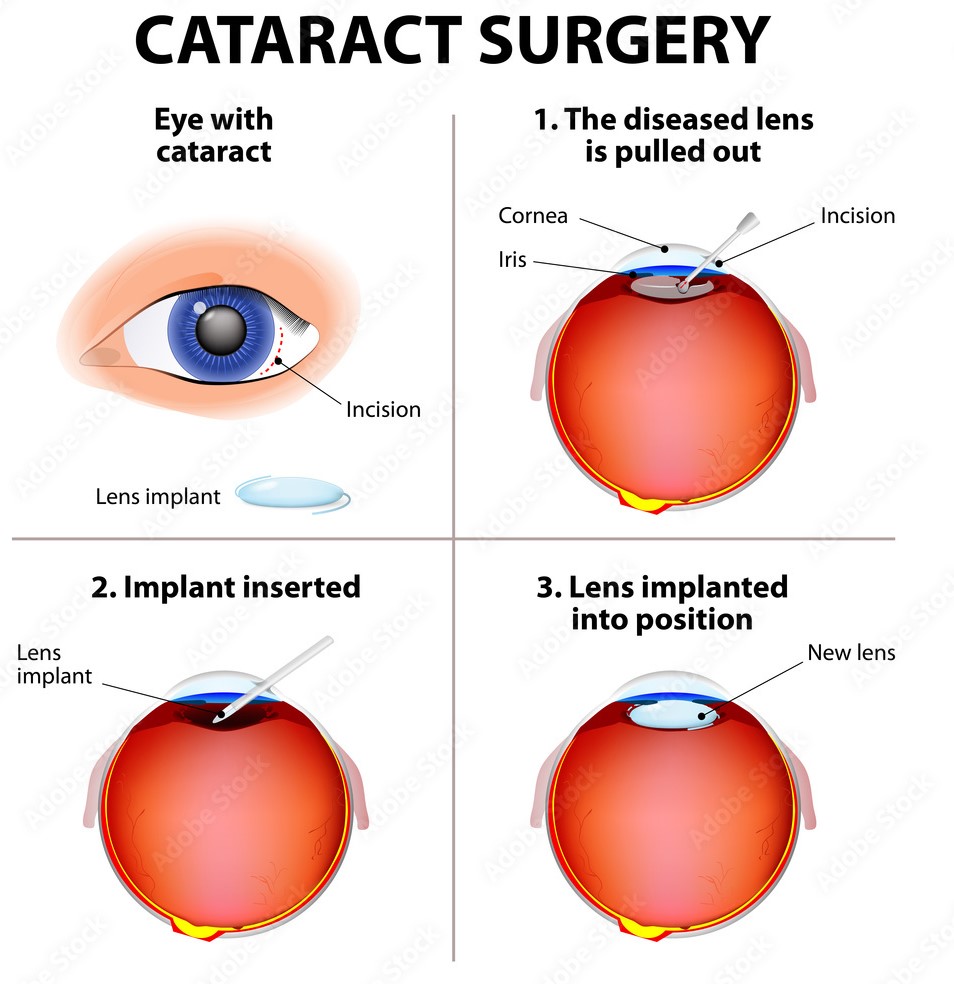 6-things-to-know-about-cataract-surgery-in-mumbai