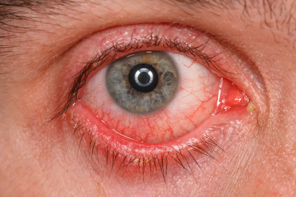 Infected eye with conjunctivitis