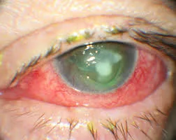 Eye infection caused by wrong way of contact lense use