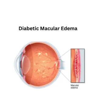 Diabetic eye disease can result in  Diabetic Macular edema.  