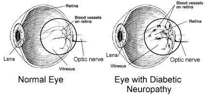 Diagram explaining Optical Neuropathy due to Diabetic eye diseases.