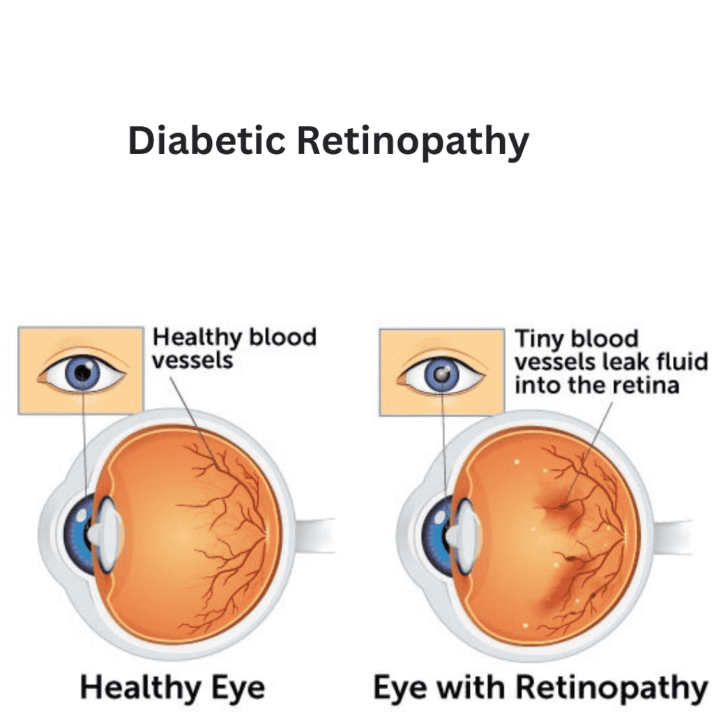 Diabetic Eye Diseases: Vision Complications, an Expert advice