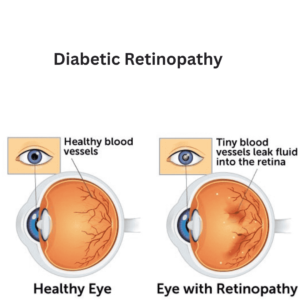 Diabetes can result into Diabetic retinopathy 