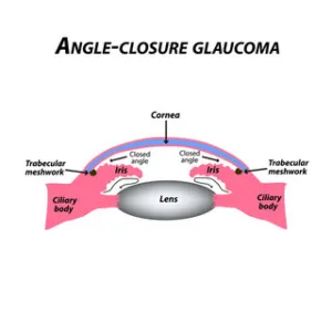 Diagram of Angle Closure Glaucoma