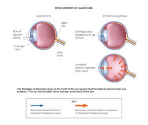 Diagram showing development of Glaucoma in eye. 