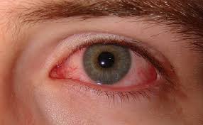 Redness in eyes is a symptoms of Dry Eye Syndrome.