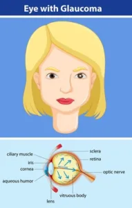 Diagram showing Eye with Glaucoma