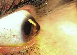 Close look of Keratoconic Eye