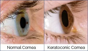 Comparison between Normal Eye Vs Keratoconic Eye