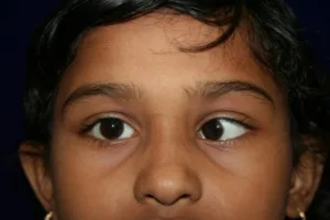 Child with Squint eyes 