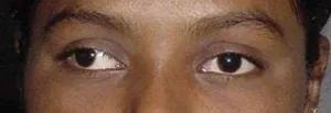 Adult male with Squint eyes with Exotropia