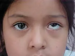 Baby girl with Squint Eyes with Hypertropia 