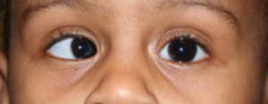 Child with squint eyes with Esotropia